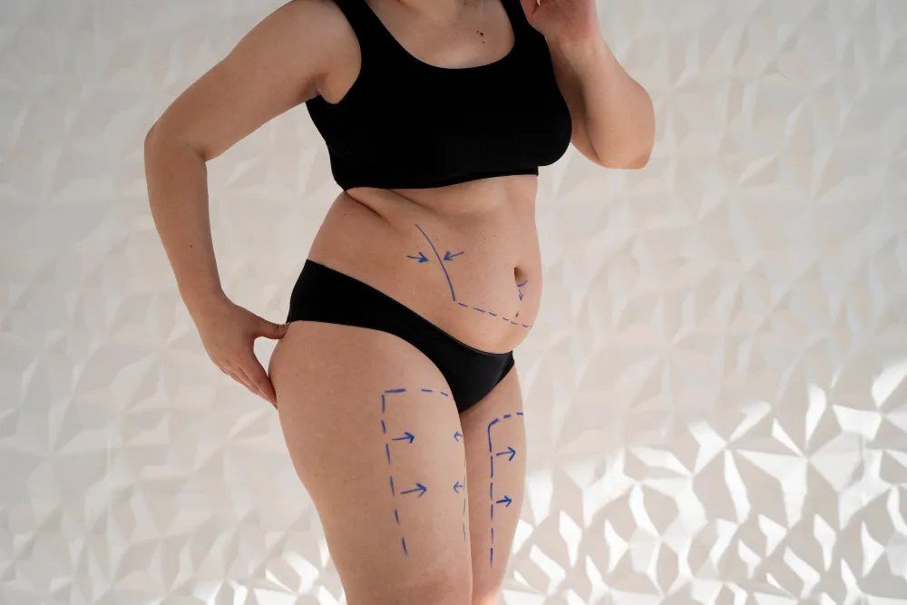 Liposuction