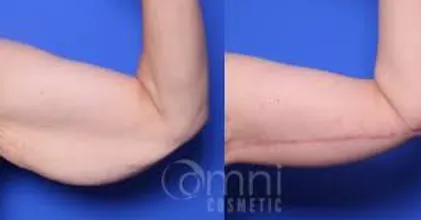 Brachioplasty