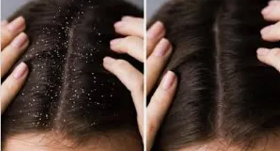 Dandruff Treatment