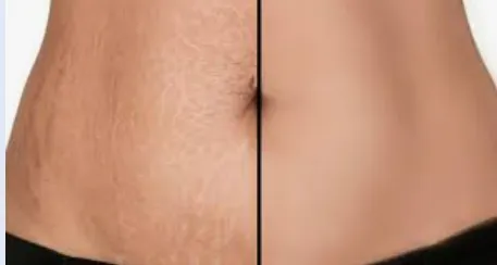 Stretch Mark Reduction