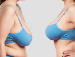 Breast Reduction