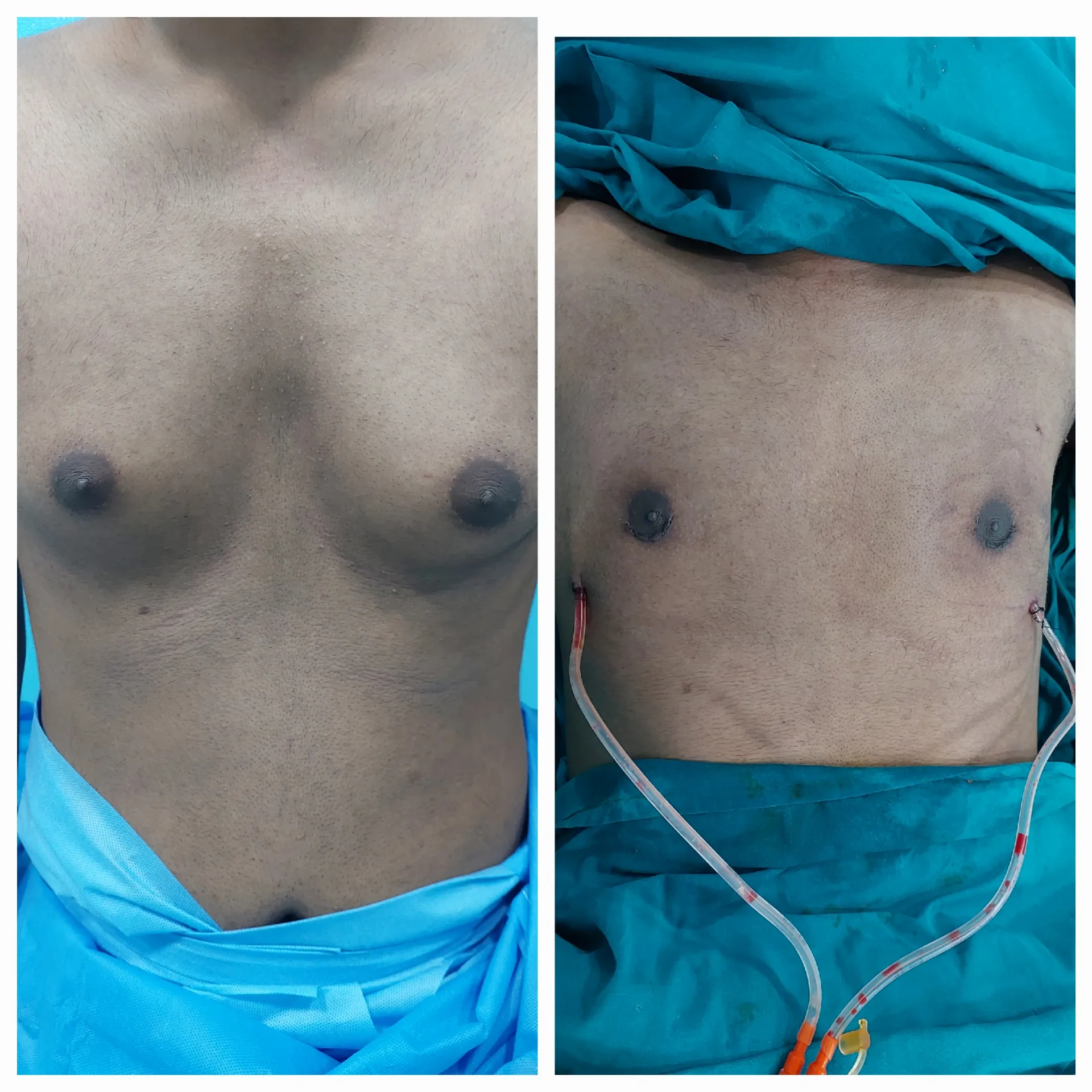 Gynecomastia