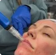 Microneedling