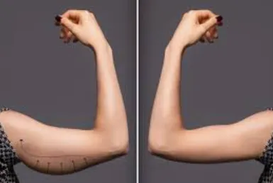 Arm Liposcution