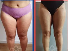 Thigh Liposuction