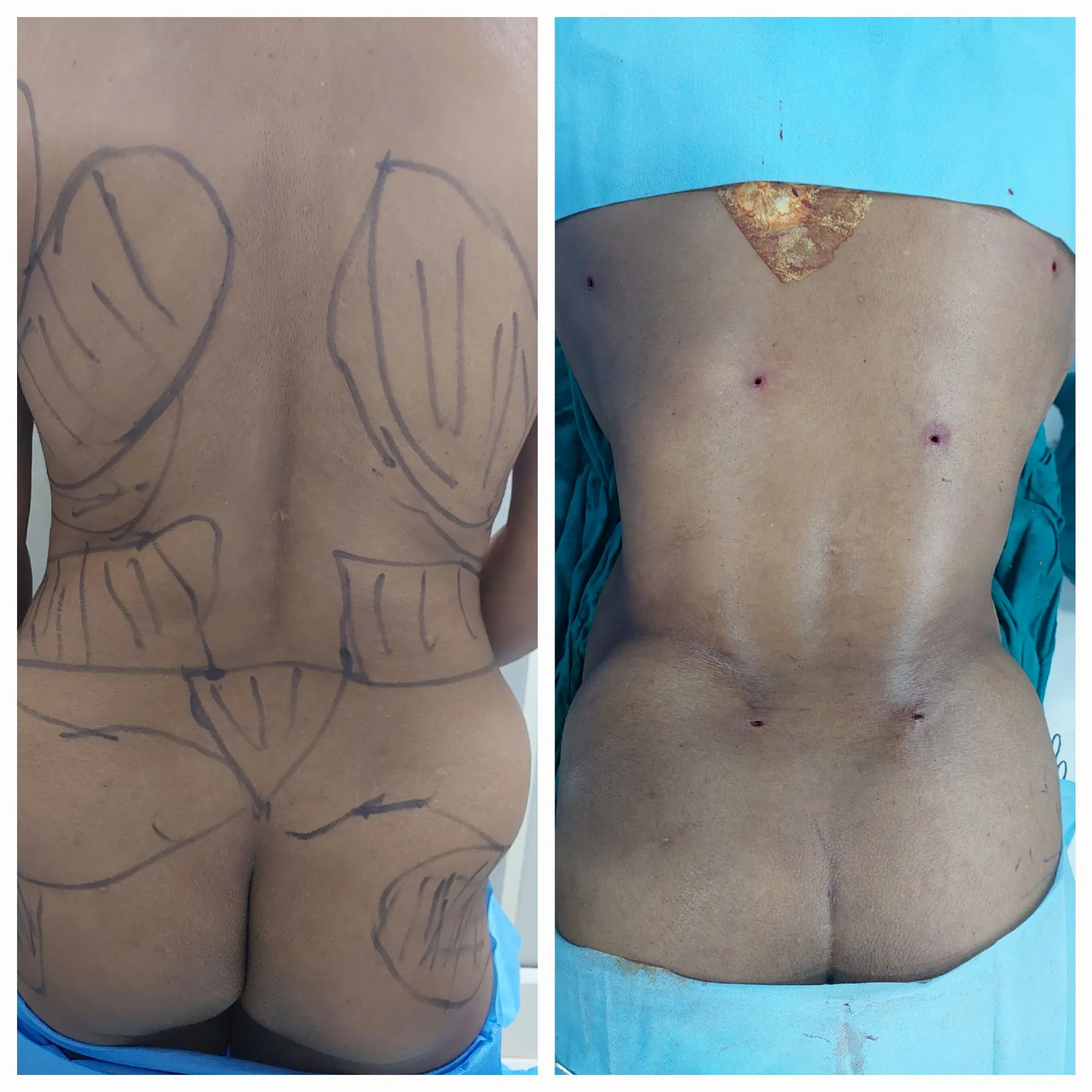 Back liposuction