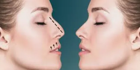 Rhinoplasty (Nose Job)