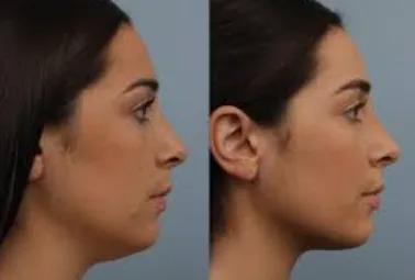 Double Chin Correction