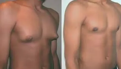 Gynaecomastia Treatment