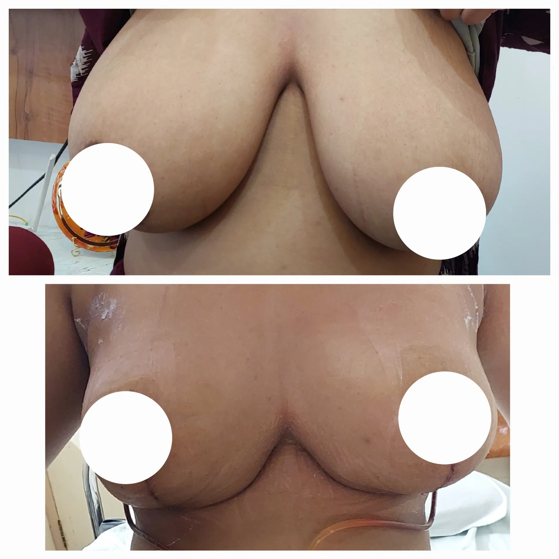 Breast reduction