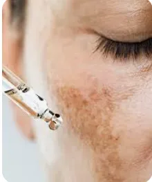 Melasma Treatment