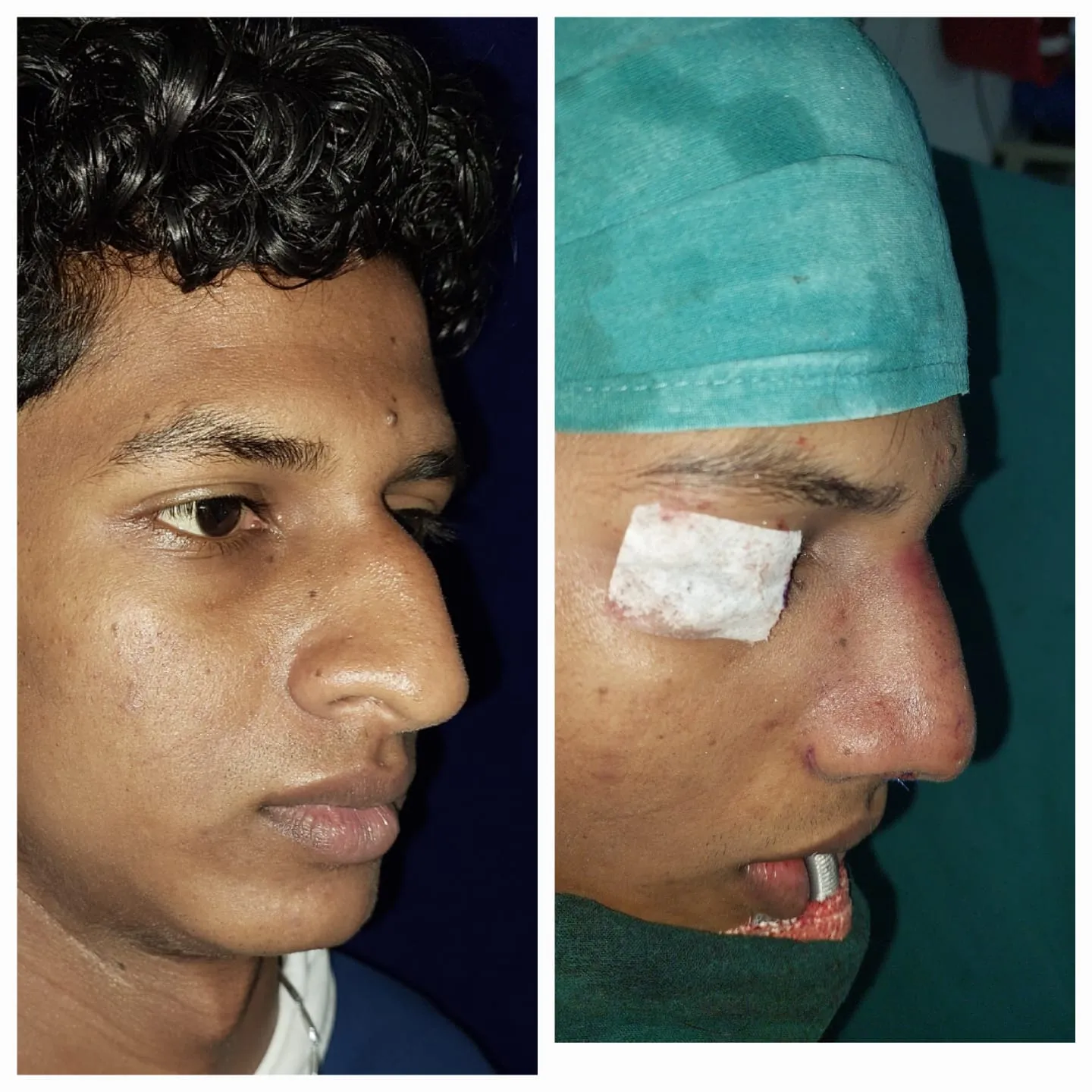 Rhinoplasty