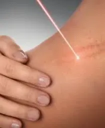 Scar Treatment
