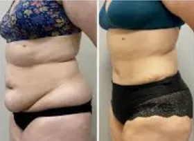 Abdominoplasty (Tummy Tuck)