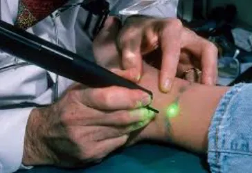 Tattoo Removal