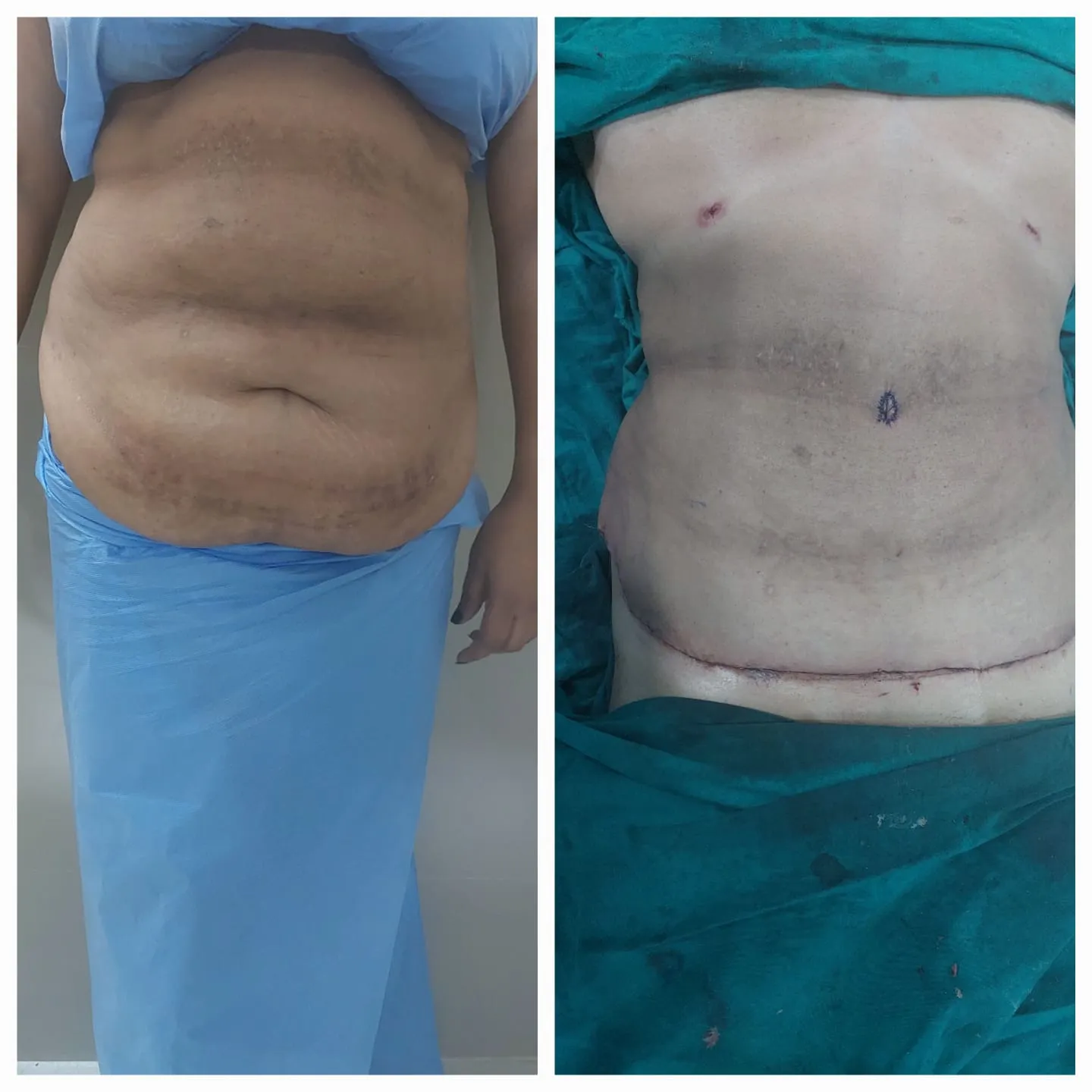 Tummy Tuck
